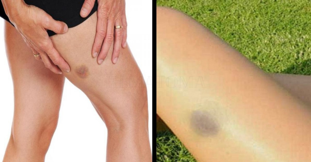 Hematomas que surgem na pele de maneira natural sem ter levado uma batida pode ser sinal de alerta