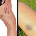 Hematomas que surgem na pele de maneira natural sem ter levado uma batida pode ser sinal de alerta